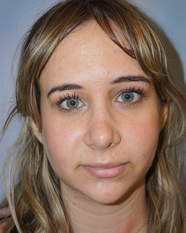 riverside-face-female-rhinoplasty-front-after-2-235A301214-A4CD-0658-C877-F90A1AE9B936.jpg