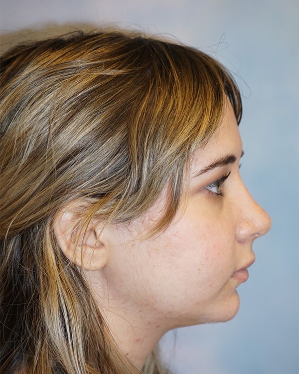 riverside-face-female-rhinoplasty-side-after-2-238A4A3CB6-FBDE-AE3C-DB1D-76567AC0B796.jpg