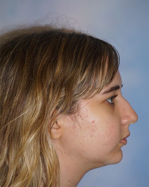 riverside-face-female-rhinoplasty-side-before-2-23F5380A73-9BFC-D4F8-3355-33ADC01B17E0.jpg