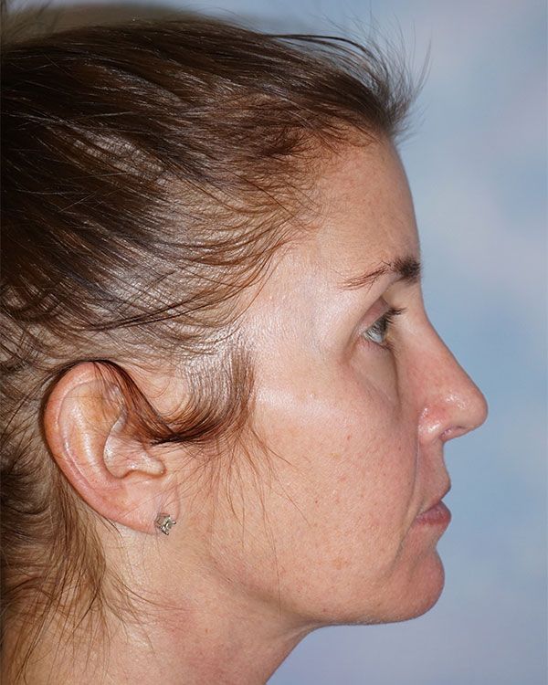 female-rhinoplasty-side-281597520-5032-3D17-06A9-96E0D6994398.jpg