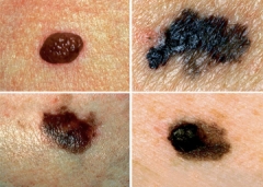 pictures of moles